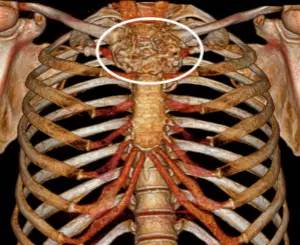 第四軍醫大學精彩分享個性化醫療3D打印的實戰案例與研究成果