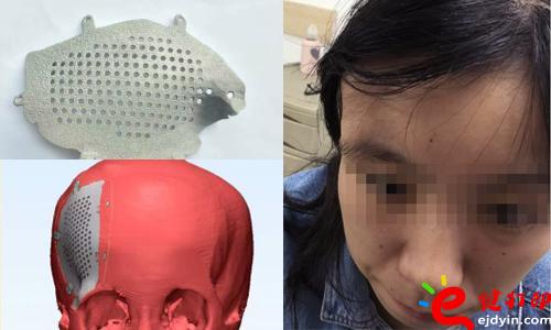 醫(yī)療3d打印應(yīng)用,醫(yī)用3d打印,3D打印假肢,3D打印脊椎,3D打印心臟,e鍵打印,3d打印服務(wù) 3D打印的顱骨假體,非常適用于發(fā)際外的顱骨缺損、病變置換,將使患者的面容恢復(fù)到正常形態(tài),完美解決了傳統(tǒng)顱骨修補(bǔ)存在的美容問題。據(jù)悉,3D打印個性化顱骨假體修補(bǔ)技術(shù)已獲國家重點研發(fā)計劃資助,能為一批病人免費提供假體,并能減免一些檢查和治療費用。未來將實行72小時的3D假體個性化顱骨修補(bǔ)術(shù),造福更多的患者。 醫(yī)療3d打印應(yīng)用,醫(yī)用3d打印,3D打印假肢,3D打印脊椎,3D打印心臟,e鍵打印,3d打印服務(wù) 3D打印的顱骨假體,非常適用于發(fā)際外的顱骨缺損、病變置換,將使患者的面容恢復(fù)到正常形態(tài),完美解決了傳統(tǒng)顱骨修補(bǔ)存在的美容問題。據(jù)悉,3D打印個性化顱骨假體修補(bǔ)技術(shù)已獲國家重點研發(fā)計劃資助,能為一批病人免費提供假體,并能減免一些檢查和治療費用。未來將實行72小時的3D假體個性化顱骨修補(bǔ)術(shù),造福更多的患者。